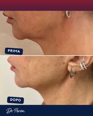 Dr Luciano Perrone Endolift