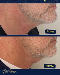 Dr Luciano Perrone Endolift
