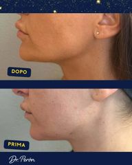 Dr Luciano Perrone Endolift