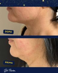 Dr Luciano Perrone Endolift