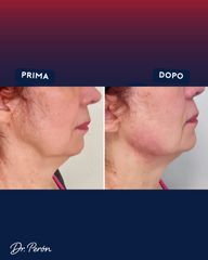 Dr Luciano Perrone Endolift