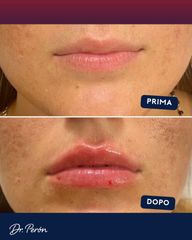 Dr Luciano Perrone Filler Labbra