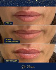 Dr Luciano Perrone Filler Labbra