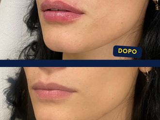 Filler labbra prima e dopo - 874711