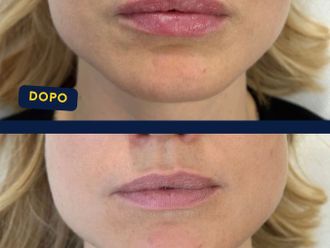 Filler labbra prima e dopo - 874712