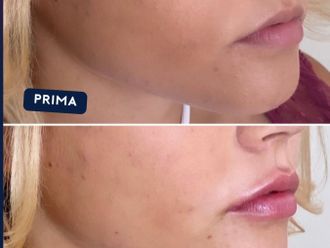 Filler labbra prima e dopo - 874713
