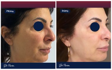 Dr Luciano Perrone Full Face Refresh