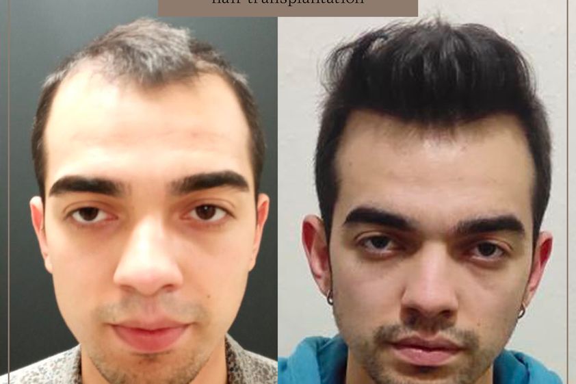 Trapianto capelli prima e dopo - 843923