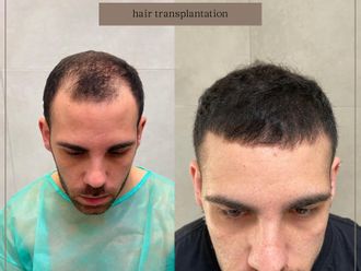 Trapianto capelli - 857952