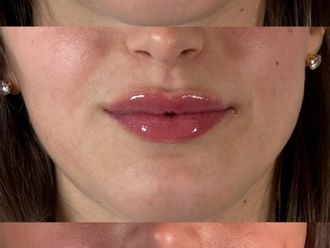 Filler labbra prima e dopo - 881081