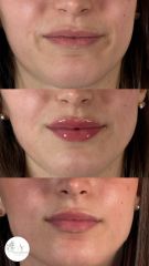 Dott.ssa Arianna Franchi Filler Labbra