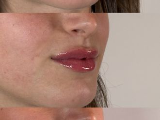 Filler labbra prima e dopo - 881086