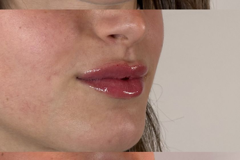 Filler labbra prima e dopo - 881086