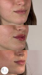 Dott.ssa Arianna Franchi Filler Labbra