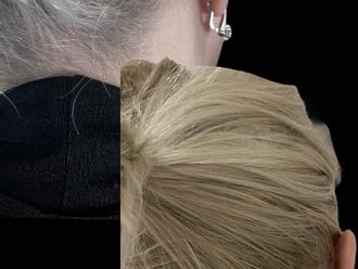 Otoplastica prima e dopo - 881104