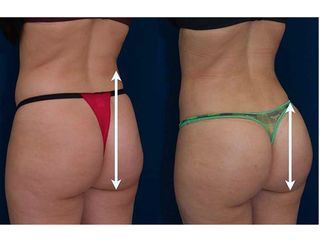 gluteoplastica prima dopo
