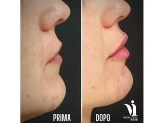 Filler labbra prima e dopo