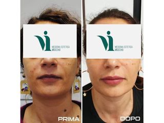 Filler labbra prima e dopo