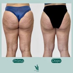 Cellulite - Dott.ssa Annalisa Visicchio