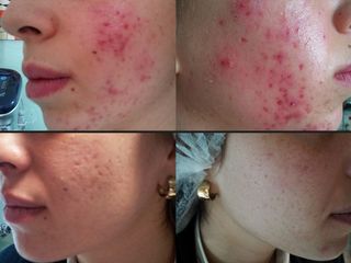 Acne prima e dopo