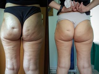 Cellulite prima e dopo