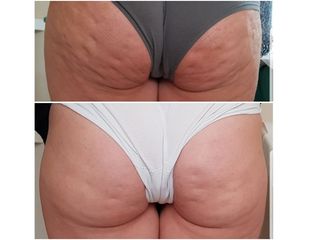 Cellulite prima e dopo