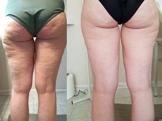 Cellulite prima e dopo