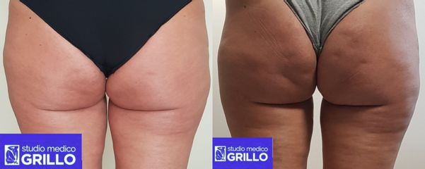 Trattamenti glutei - Dott.ssa Aurora Maria Grillo