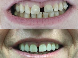 Faccette dentali prima e dopo - 867535