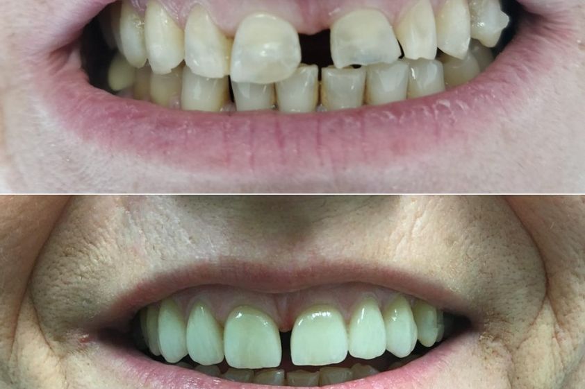 Faccette dentali prima e dopo - 867535