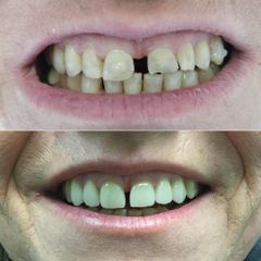 Faccette dentali - Centro Odontoiatria Integrata