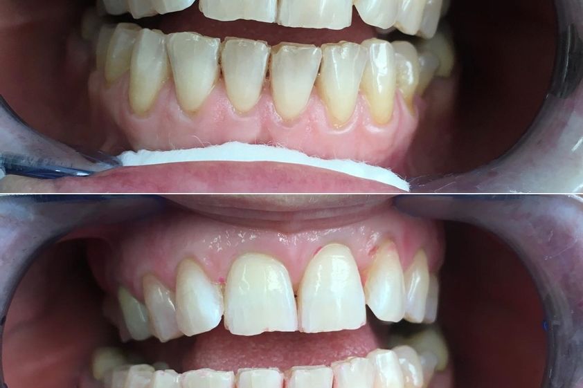 Sbiancamento denti prima e dopo - 867537