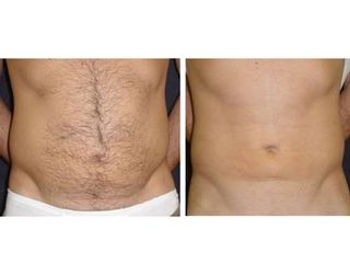 liposcultura prima dopo