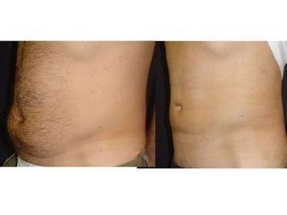 liposcultura prima dopo
