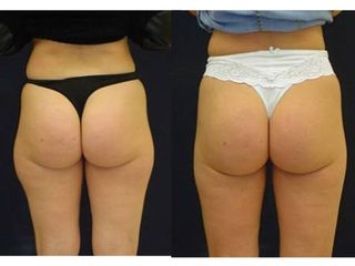 Gluteoplastica prima dopo
