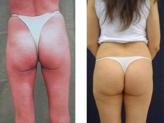 Gluteoplastica prima dopo