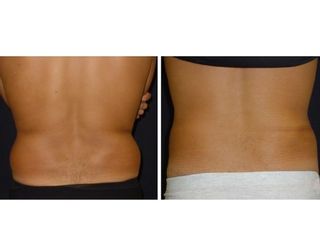 Liposcultura prima dopo
