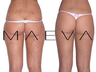 Lipolaser prima e dopo