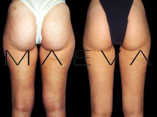Lipolaser prima e dopo