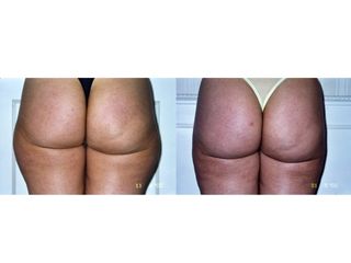 Liposuzione prima e dopo