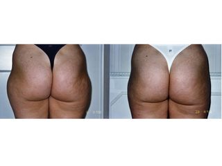 Liposuzione prima e dopo