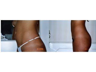 Liposuzione prima e dopo
