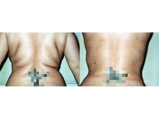 Liposcultura prima e dopo