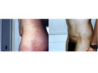 Addominoplastica prima e dopo