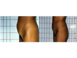 Liposuzione prima e dopo
