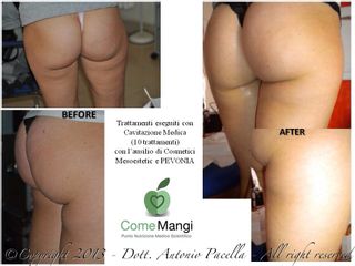 cavitazione prima dopo