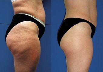 Cellulite prima dopo