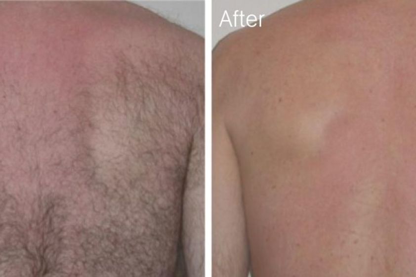Depilazione laser prima e dopo - 746736