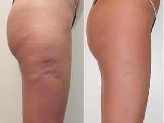 Cellulite prima dopo