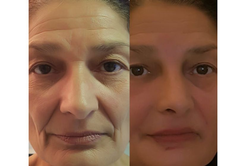 HIFU prima e dopo - 764328